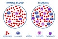 Leukemia. blood cancer. Royalty Free Stock Photo